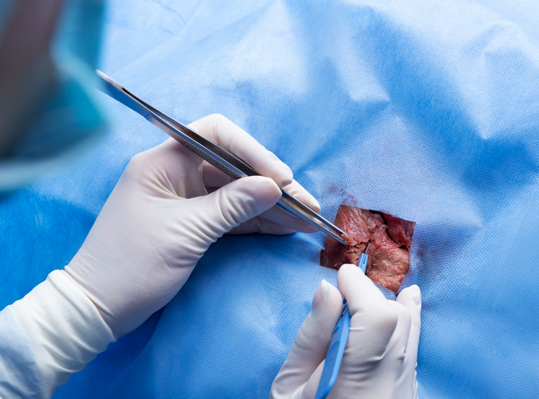 Trasplante de hígado